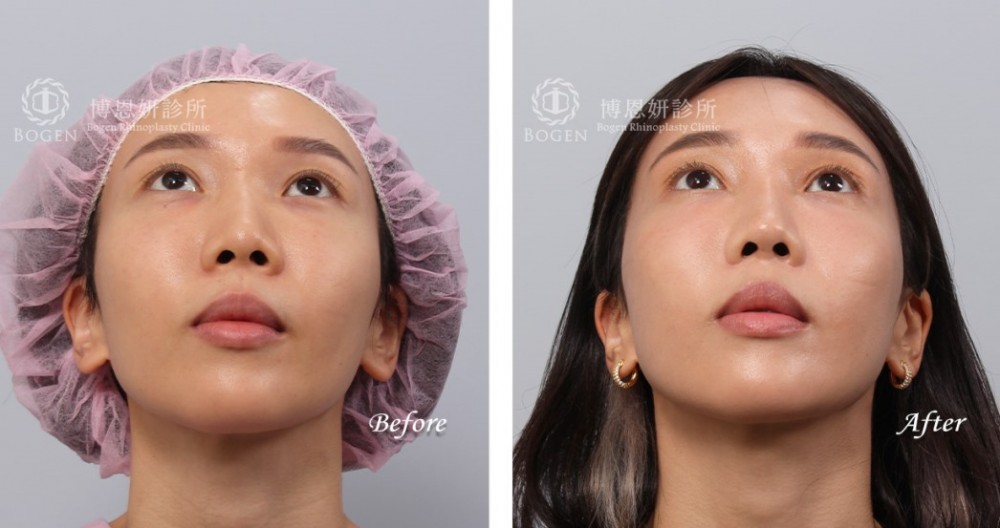 韓式隆鼻,結構式隆鼻,博恩妍